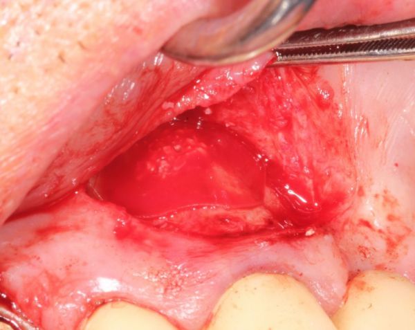 Proguard in an apicectomy operation